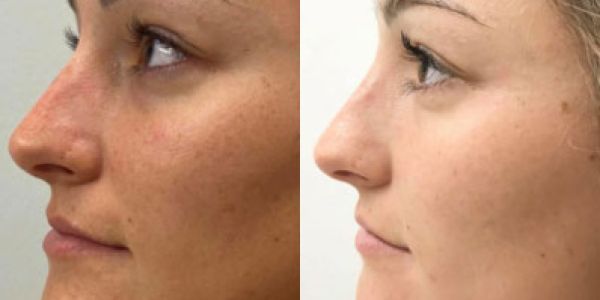 Before and After of Microneedling with RF using the Virtue system at Rejuvenate Med Spa of Kansas City